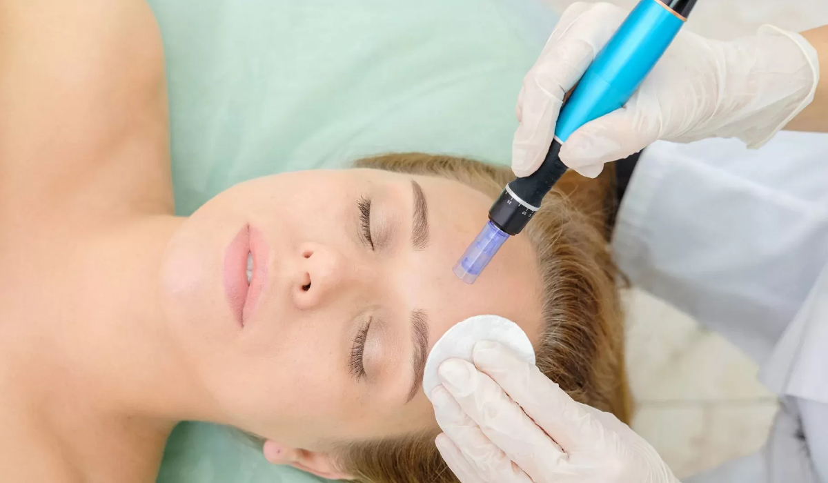 Microneedling new